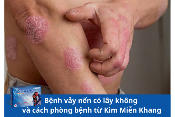 Bệnh vảy nến có lây không và cách phòng bệnh từ Kim Miễn Khang