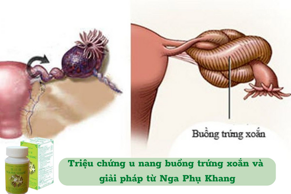Triệu chứng u nang buồng trứng xoắn và giải pháp từ Nga Phụ Khang