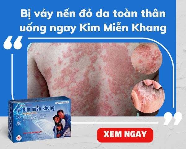 Vảy nến đỏ da toàn thân và giải pháp từ Kim Miễn Khang