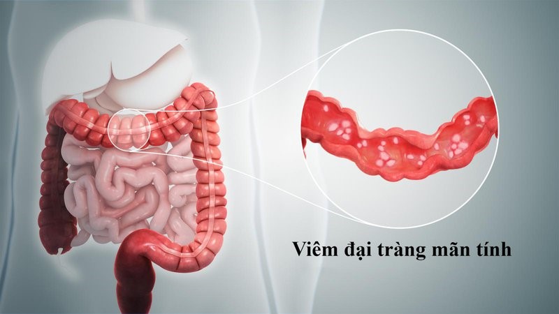 Nguyên nhân viêm đại tràng và cách cải thiện hiệu quả với Đại tràng Á Âu