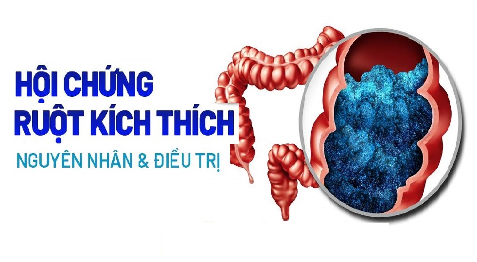 Tất tần tật về hội chứng ruột kích thích và giải pháp từ Đại tràng Á Âu
