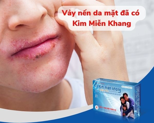 Bị vảy nến da mặt ngại không dám đi đâu, đã có Kim Miễn Khang