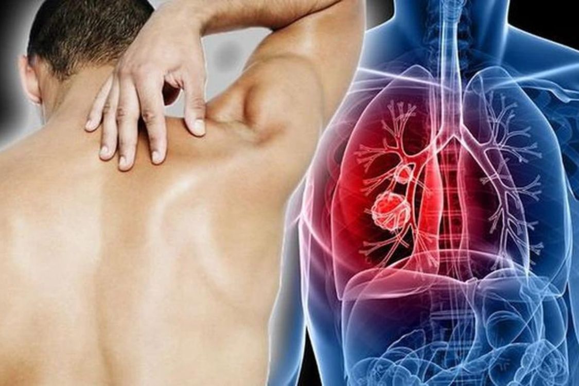 Phòng ngừa và giảm nguy cơ mắc ung thư phổi tế bào nhỏ nhờ Tumolung