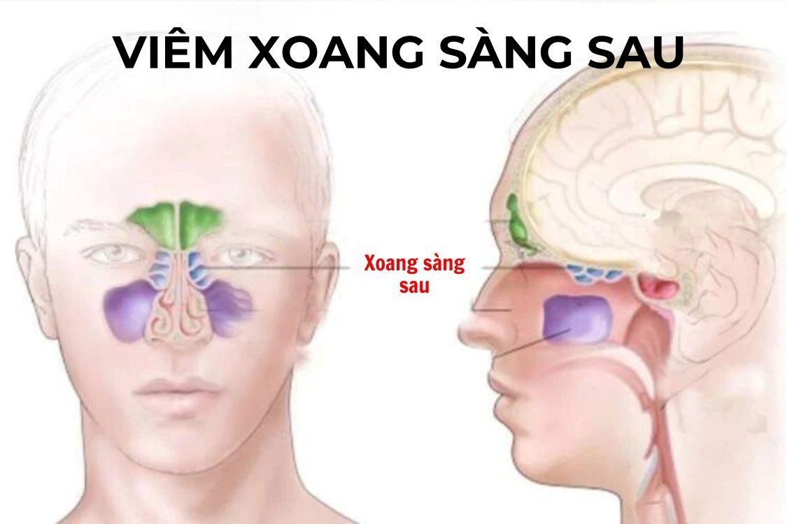 Đẩy lùi hiệu quả viêm xoang sàng sau với giải pháp thảo dược từ Xịt mũi họng Khiết Thanh