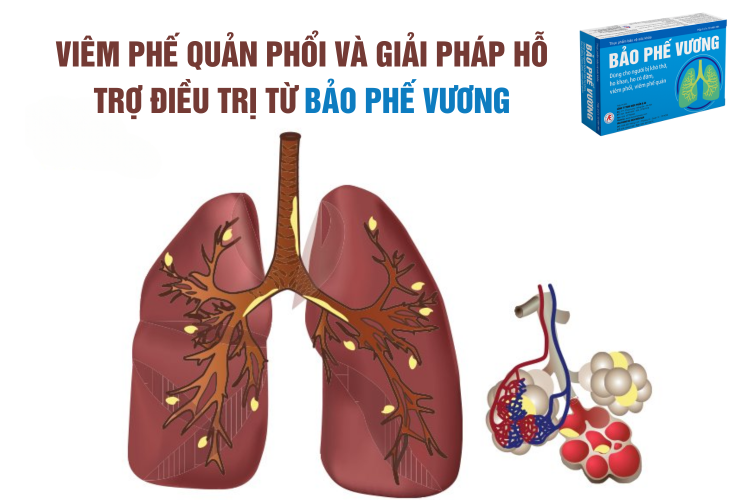 Viêm phế quản phổi Nguyên nhân và giải pháp hỗ trợ điều trị từ Bảo Phế Vương