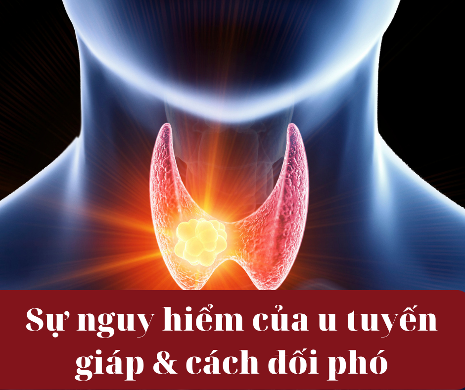 U tuyến giáp có nguy hiểm không và giải pháp từ Ích Giáp Vương