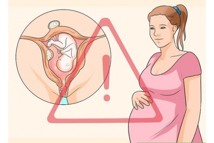 Bị u xơ tử cung có mang thai được không và giải pháp từ Nga Phụ Khang