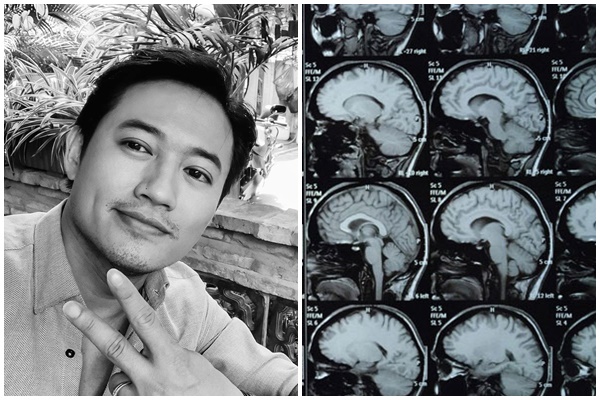 Căn bệnh u não diễn viên Quý Bình mắc phải nguy hiểm như thế nào