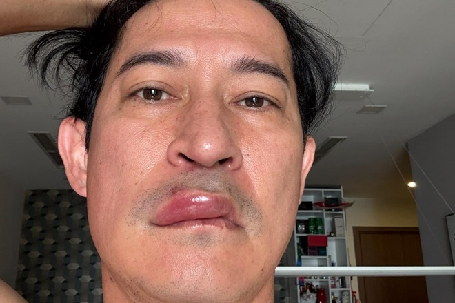 Giật mình hình ảnh diễn viên Huy Khánh với gương mặt biến dạng, sưng phù