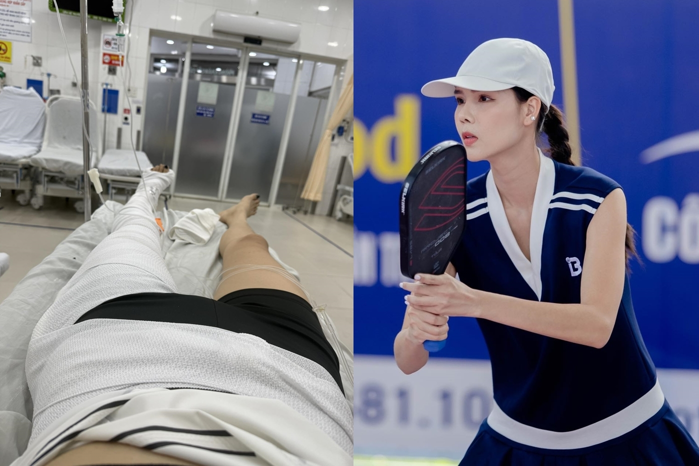 Vợ Mạc Hồng Quân gãy xương đùi, bó bột đến mức nhìn thôi cũng thấy quá đau