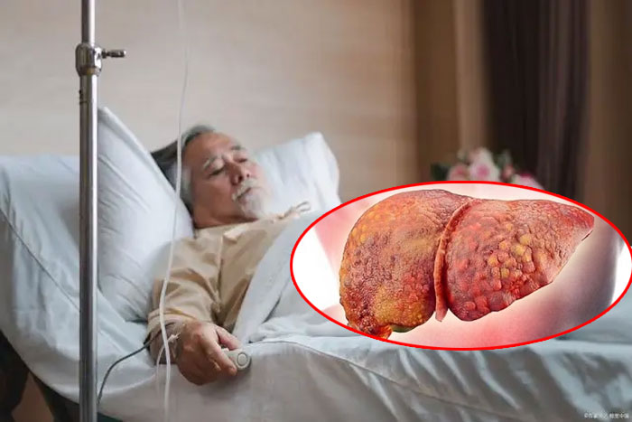 Ngày càng có nhiều người chết vì ung thư gan! Bác sĩ nhắc nhở Ăn ít khoai tây chiên và ăn nhiều 3 loại thực phẩm này