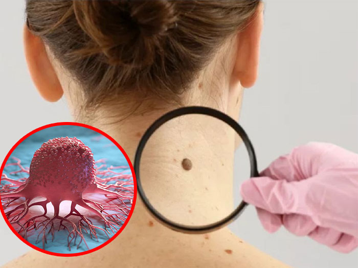 Lưu ý Nốt ruồi ở ba vị trí này có liên quan mật thiết đến ung thư, nên xử lý kịp thời