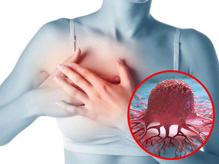 Bác sĩ cảnh báo dấu hiệu sớm của ung thư vú thường bị bỏ qua