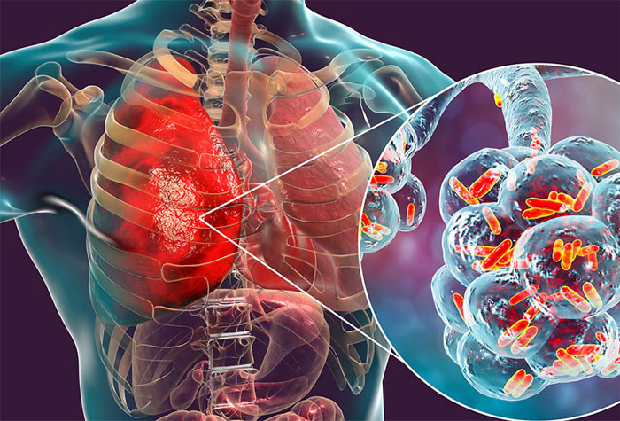 Ung thư phổi không triệu chứng trở thành chủ đề nóng! Bác sĩ nhắc nhở Cần cảnh giác những dấu hiệu này