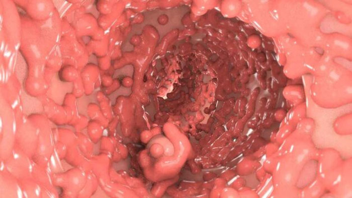 2 loại polyp đại tràng gần như 100% chuyển thành ung thư! 4 biểu hiện khi đi vệ sinh cảnh báo nguy hiểm