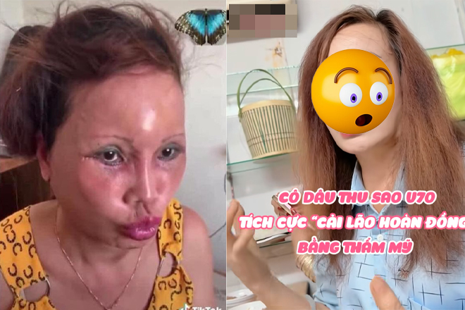 Cô dâu Cao Bằng lại dao kéo lần thứ n, diện mạo mới nhiều người ngã ngửa