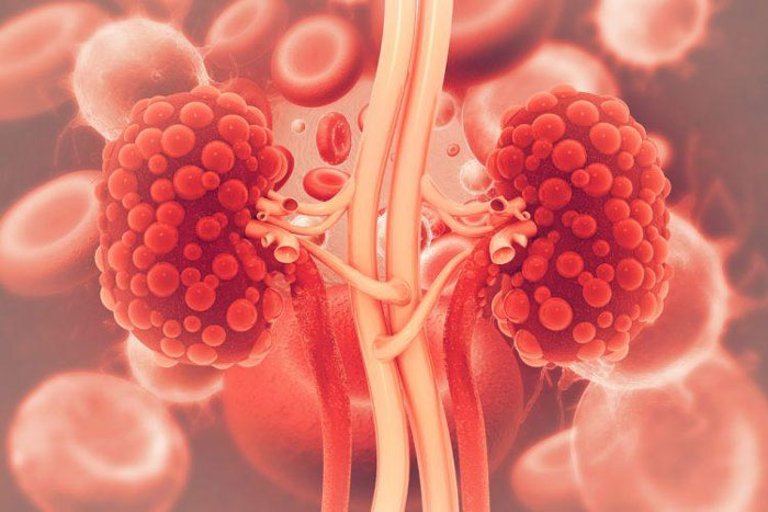 Người thức khuya thường xuyên dễ mắc bệnh thận 2 nhóm đối tượng này có nguy cơ cao