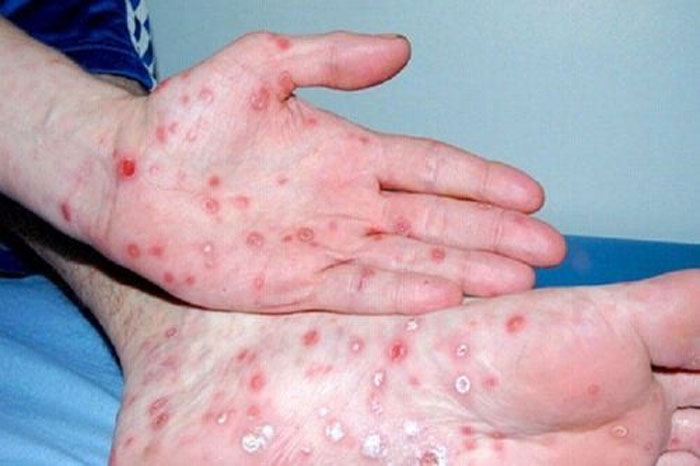 Tại sao ngày càng nhiều người mắc giang mai Cảnh báo Ngoài quan hệ tình dục nguy cơ cao, 3 hành vi cần được kiểm soát