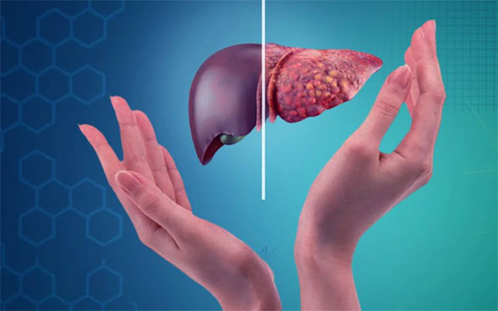 Nghiên cứu mới Bổ sung đủ vitamin D có thể giảm 35% nguy cơ ung thư gan, 57% nguy cơ xơ gan!