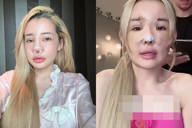 Sốc gương mặt biến dạng của Ngân 98 sau hơn 10 lần dao kéo