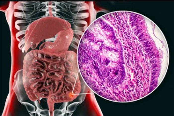 Tưởng rối loạn tiêu hóa, ai ngờ là ung thư 5 dấu hiệu trực tràng không nên xem thường