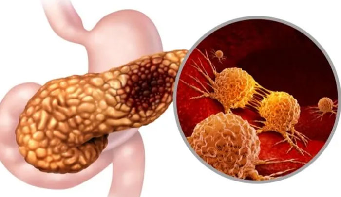 4 dấu hiệu cảnh báo ung thư tuyến tụy, nhiều người bỏ qua vì tưởng bình thường