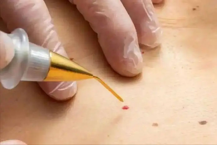 Nốt ruồi son xuất hiện trên cơ thể, dấu hiệu của bệnh nguy hiểm Bác sĩ Nếu có 3 đặc điểm bất thường cần đi khám