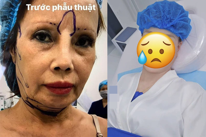 Cô dâu Cao Bằng lại thẩm mỹ ở tuổi U70, diện mạo sau can thiệp mới sốc