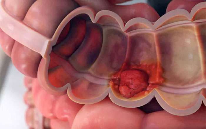 Đi vệ sinh thấy 5 dấu hiệu này, đi khám ngay kẻo ung thư ghé thăm