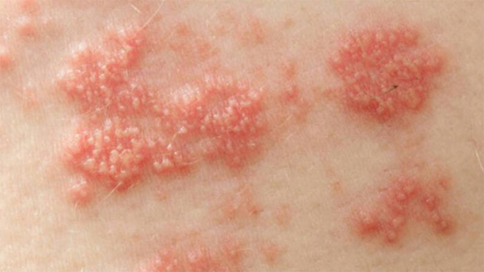 Dù là nam hay nữ, nếu 3 vị trí này trên cơ thể ngứa ngáy, rất có thể bạn đã mắc phải bệnh lây truyền qua đường tình dục! 