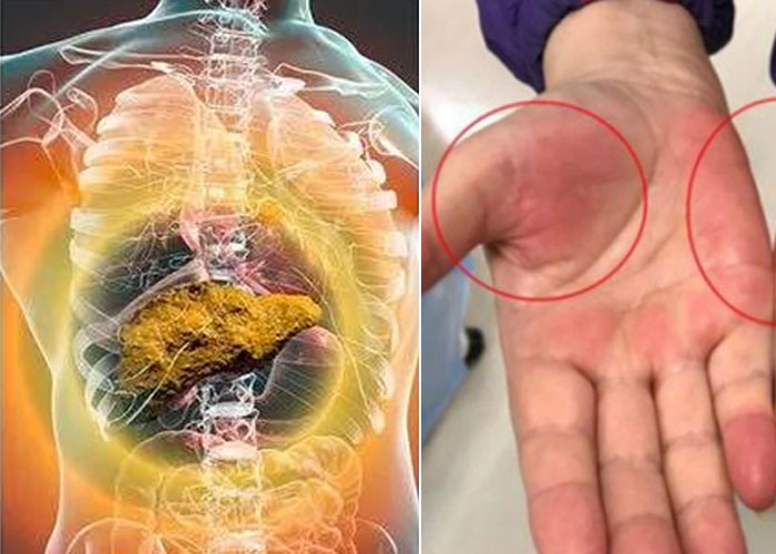 Gan không tốt, da sẽ báo trước! Người bị tổn thương gan sẽ xuất hiện 4 dấu hiệu bất thường này trên da