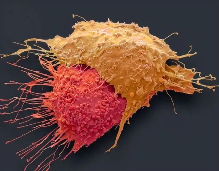 Người dễ mắc ung thư đại tràng thường có 4 thói quen này, hi vọng bạn không có!