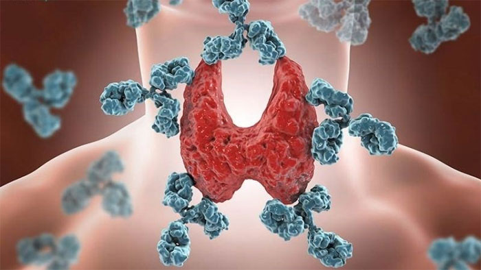 5 dấu hiệu cảnh báo u tuyến giáp đã chuyển sang ung thư, đừng xem thường 