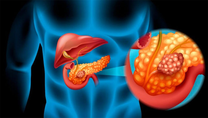 4 dấu hiệu bất thường, cảnh giác với ung thư tuyến tụy