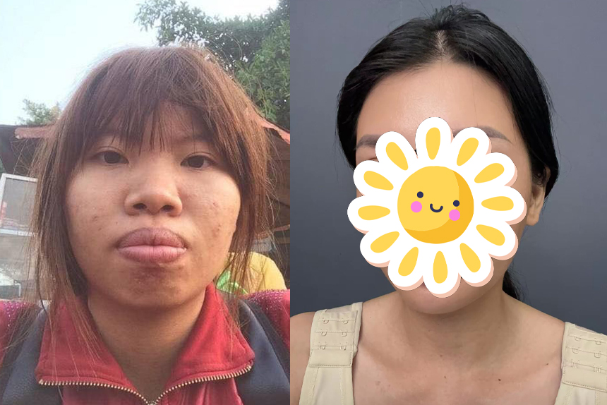 Giật mình diện mạo hiện tại của Thị Nở tái sinh Quách Phượng sau 8 năm dao kéo