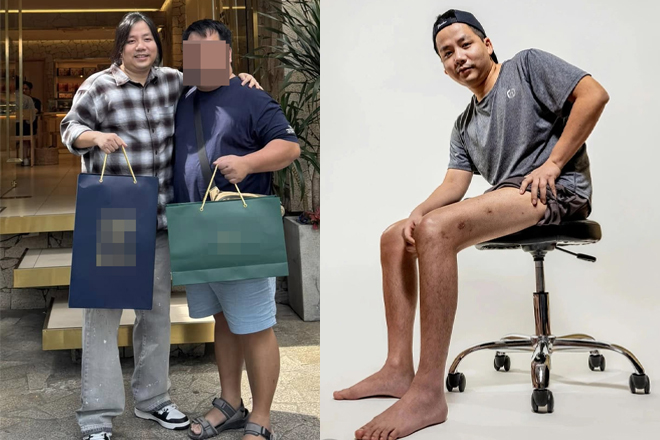 Sốc hình ảnh trên ngắn dưới dài của Khoa Pug sau 2 lần chi tiền tỷ phẫu thuật kéo chân