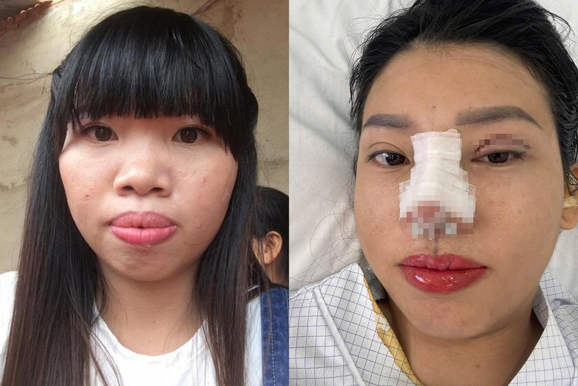 Thị Nở tái sinh Quách Phượng tiếp tục phẫu thuật thẩm mỹ, diện mạo mới gây bất ngờ