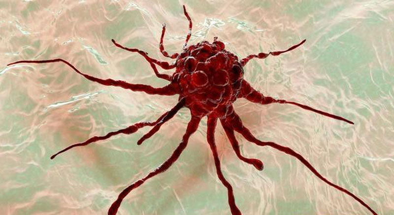 Có khối u ác tính hay không Bạn có thể nhận biết bằng cách quan sát phần thân dưới! 