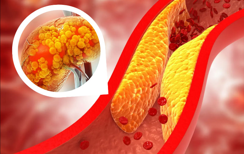 Rau diếp có phải cứu tinh của mỡ máu cao Bác sĩ nhắc nhở Muốn ổn định mỡ máu, nên ăn nhiều 6 loại rau này