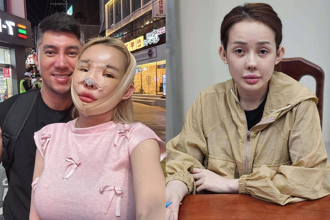 Lương Bằng Quang lo sợ mũi Ngân 98 bị hoại tử