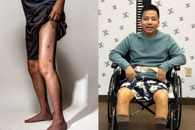 Sốc bước đi tập tễnh, di chuyển không vững của Khoa Pug sau 2 lần chi tiền tỷ kéo chân