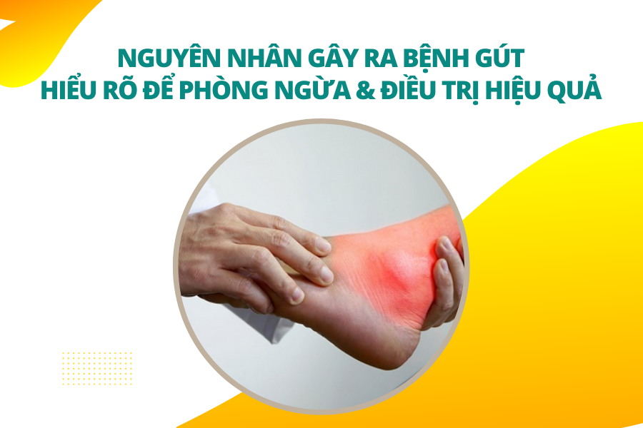 Nguyên nhân gây ra bệnh gút Hiểu rõ để phòng ngừa và điều trị hiệu quả