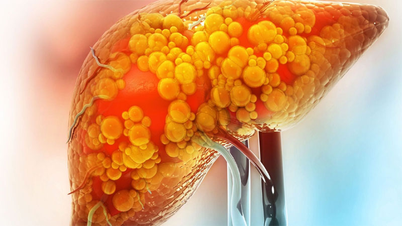 5 cách vận động đánh bay gan nhiễm mỡ, đừng bỏ lỡ! 