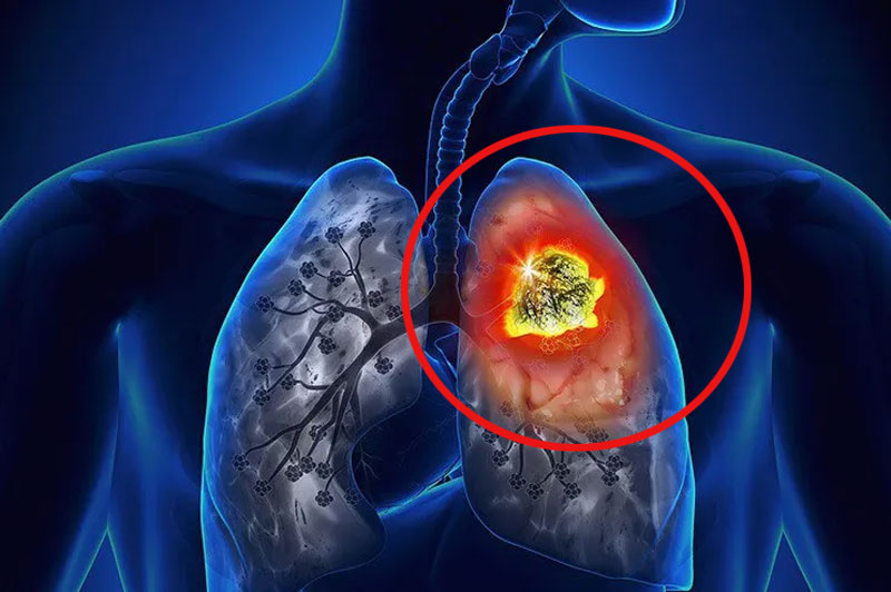 Nếu xuất hiện dấu hiệu này trên bàn tay, rất có thể bạn đã bị ung thư phổi! Những người từ 40-70 tuổi đừng bỏ qua!