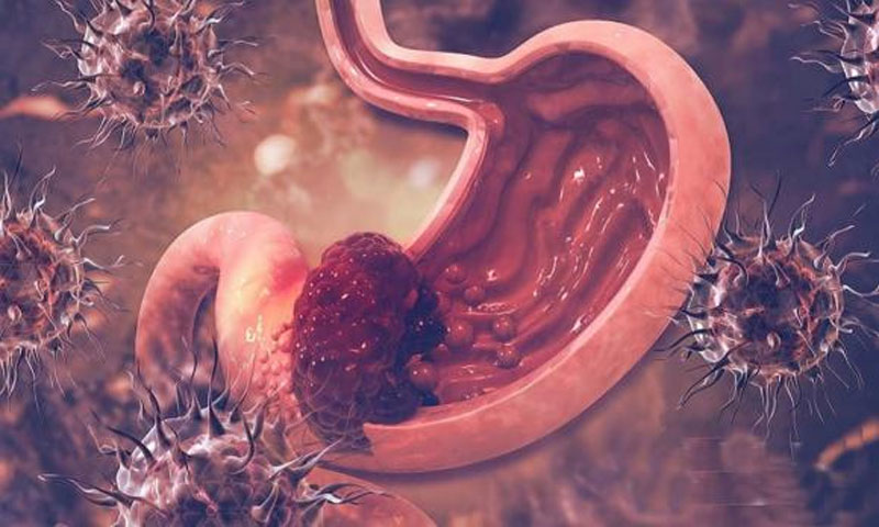 Không phải tự nhiên bị ung thư dạ dày! Nghiên cứu phát hiện người mắc bệnh liên quan đến 5 điều sau! 