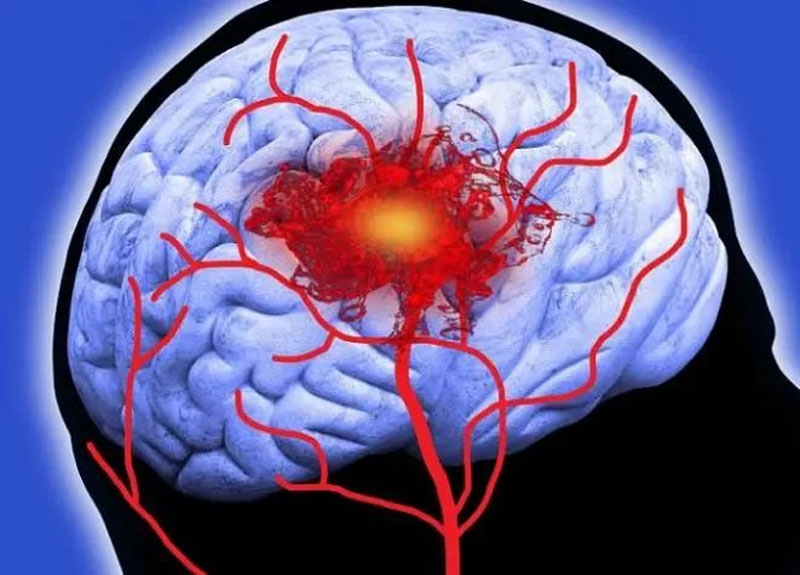 Đột quỵ dễ xảy ra hơn trong thời gian này! Làm 8 điều trong mùa đông để giảm nguy cơ