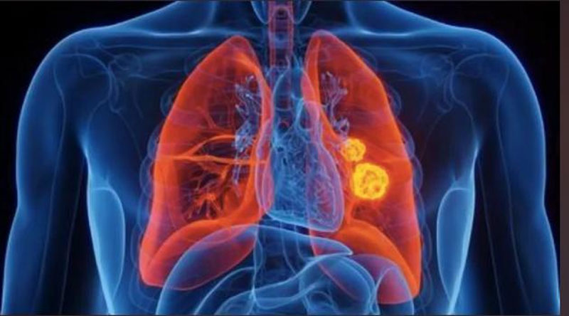 Nhiều người thường bỏ qua những dấu hiệu đầu tiên của ung thư phổi 