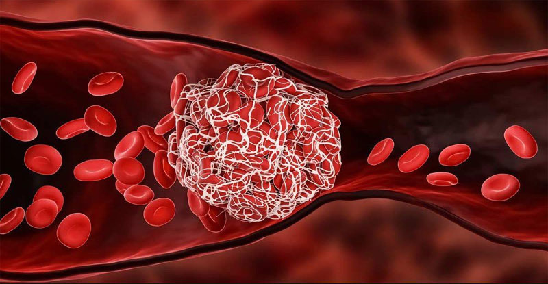 Tắc mạch máu có thể nhận biết qua mặt và chân! 6 dấu hiệu không nên bỏ qua