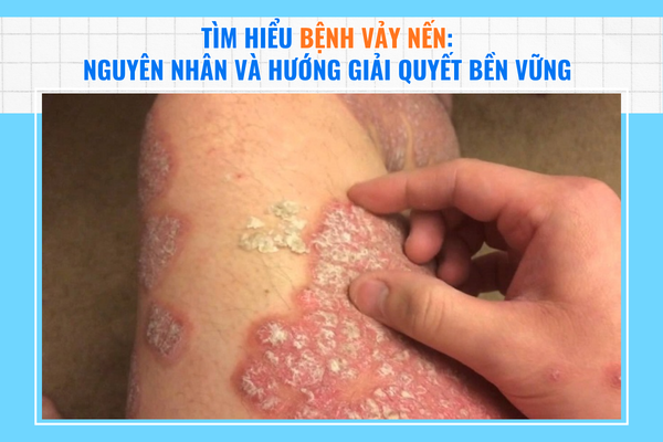 Tìm hiểu bệnh vảy nến Nguyên nhân và hướng giải quyết bền vững